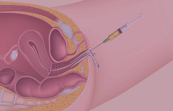 IUI fertility procedure helps couples conceive with advanced reproductive & pregnancy in Coimbatore